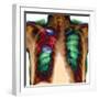 Pneumonia, X-ray-Du Cane Medical-Framed Premium Photographic Print