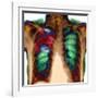 Pneumonia, X-ray-Du Cane Medical-Framed Photographic Print