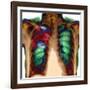 Pneumonia, X-ray-Du Cane Medical-Framed Photographic Print