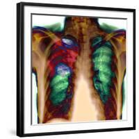 Pneumonia, X-ray-Du Cane Medical-Framed Photographic Print