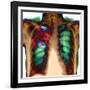 Pneumonia, X-ray-Du Cane Medical-Framed Photographic Print