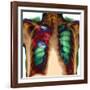 Pneumonia, X-ray-Du Cane Medical-Framed Photographic Print