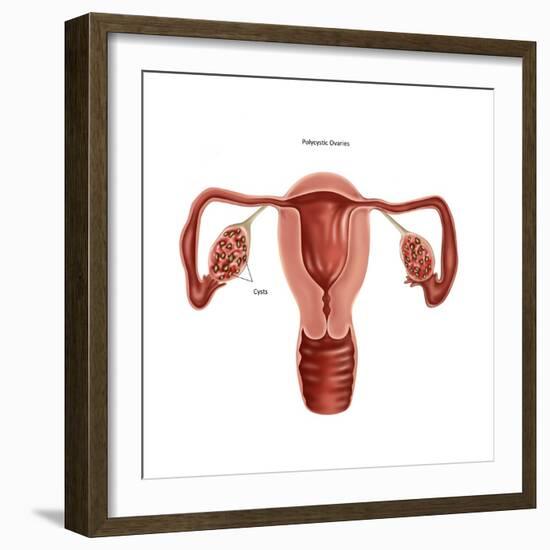 Polycystic Ovaries-Gwen Shockey-Framed Art Print