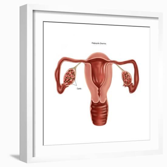 Polycystic Ovaries-Gwen Shockey-Framed Art Print