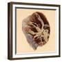 Pulmonary Clot, Illustration, 1844-Science Source-Framed Giclee Print