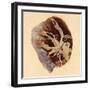 Pulmonary Clot, Illustration, 1844-Science Source-Framed Giclee Print