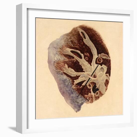 Pulmonary Clot, Illustration, 1844-Science Source-Framed Giclee Print