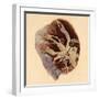 Pulmonary Clot, Illustration, 1844-Science Source-Framed Giclee Print