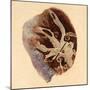 Pulmonary Clot, Illustration, 1844-Science Source-Mounted Giclee Print