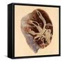 Pulmonary Clot, Illustration, 1844-Science Source-Framed Stretched Canvas