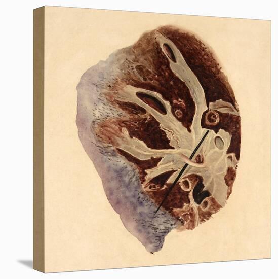 Pulmonary Clot, Illustration, 1844-Science Source-Stretched Canvas