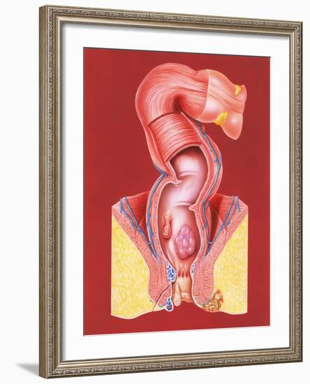 Rectal Disorders-John Bavosi-Framed Photographic Print