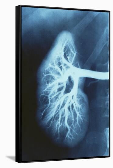 Renal Blood Vessels, X-ray-null-Framed Stretched Canvas