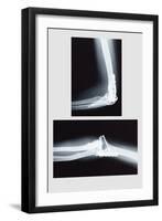 Repaired Elbow-null-Framed Art Print