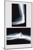 Repaired Elbow-null-Mounted Art Print