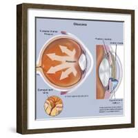 Retina of Eye with Glaucoma-null-Framed Art Print