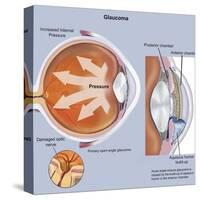 Retina of Eye with Glaucoma-null-Stretched Canvas