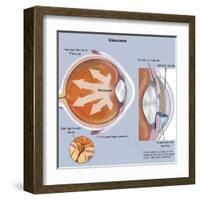 Retina of Eye with Glaucoma-null-Framed Art Print