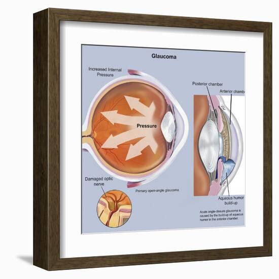 Retina of Eye with Glaucoma-null-Framed Art Print