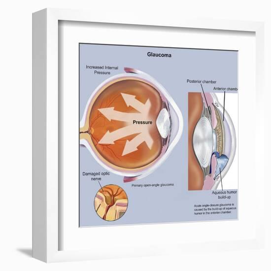 Retina of Eye with Glaucoma-null-Framed Art Print