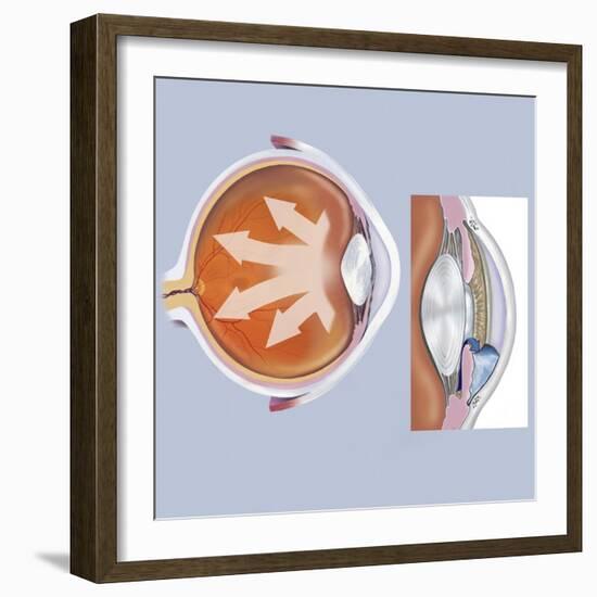 Retina of Eye with Glaucoma-null-Framed Art Print