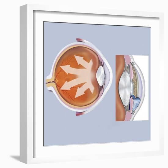 Retina of Eye with Glaucoma-null-Framed Art Print