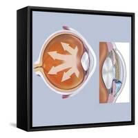 Retina of Eye with Glaucoma-null-Framed Stretched Canvas