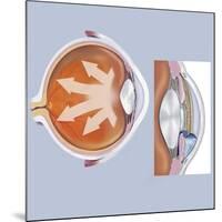 Retina of Eye with Glaucoma-null-Mounted Art Print