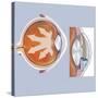 Retina of Eye with Glaucoma-null-Stretched Canvas