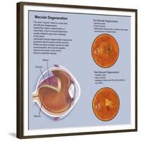 Retina with Macular Degeneration-null-Framed Premium Giclee Print