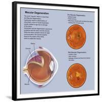 Retina with Macular Degeneration-null-Framed Premium Giclee Print