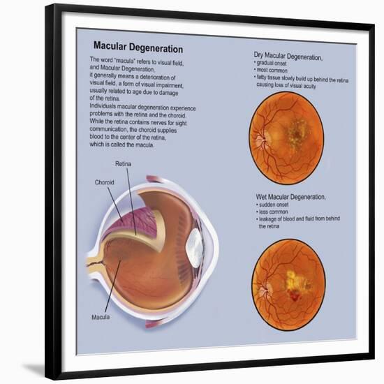 Retina with Macular Degeneration-null-Framed Premium Giclee Print