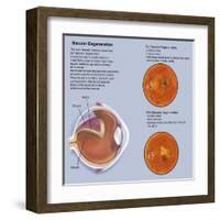 Retina with Macular Degeneration-null-Framed Art Print