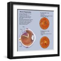 Retina with Macular Degeneration-null-Framed Art Print