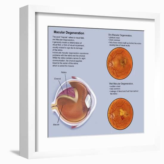 Retina with Macular Degeneration-null-Framed Art Print