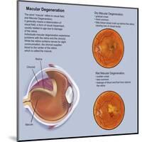 Retina with Macular Degeneration-null-Mounted Art Print