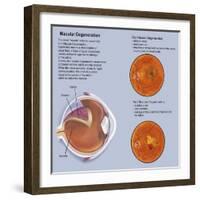 Retina with Macular Degeneration-null-Framed Art Print