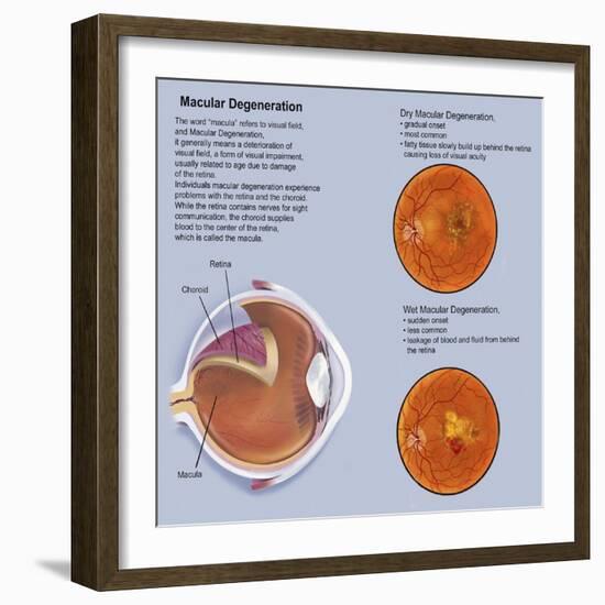 Retina with Macular Degeneration-null-Framed Art Print