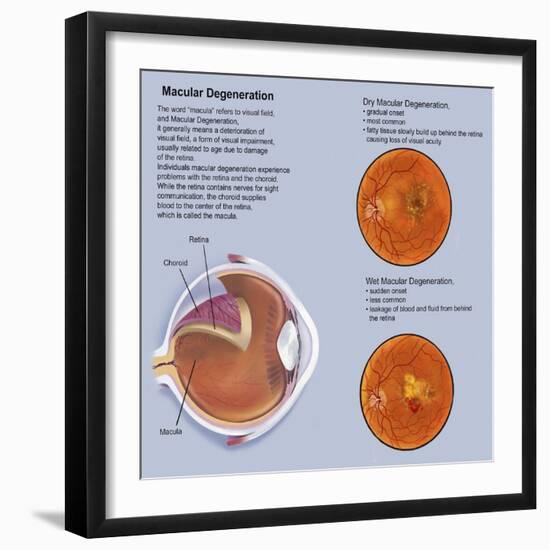 Retina with Macular Degeneration-null-Framed Art Print