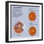 Retina with Macular Degeneration-null-Framed Art Print