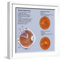 Retina with Macular Degeneration-null-Framed Art Print