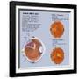 Retina with Macular Degeneration-null-Framed Art Print