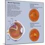 Retina with Macular Degeneration-null-Mounted Art Print