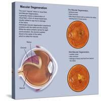 Retina with Macular Degeneration-null-Stretched Canvas