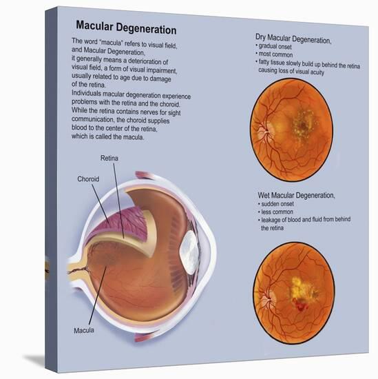 Retina with Macular Degeneration-null-Stretched Canvas