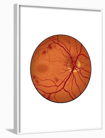 Retina with Neovascularization-null-Framed Art Print
