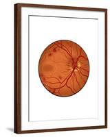 Retina with Neovascularization-null-Framed Art Print