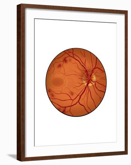 Retina with Neovascularization-null-Framed Art Print