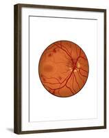 Retina with Neovascularization-null-Framed Art Print