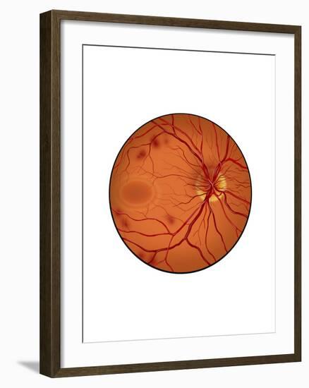 Retina with Neovascularization-null-Framed Art Print